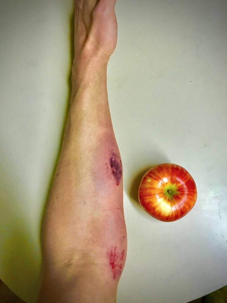 Arm Welt Locking Out
